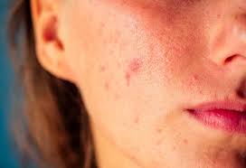 How to deal with acne breakouts in summers?