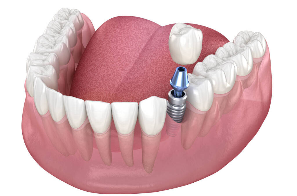 Dental Implants Cost: 3 Tips for Finding Affordable Dental Implants in Dublin